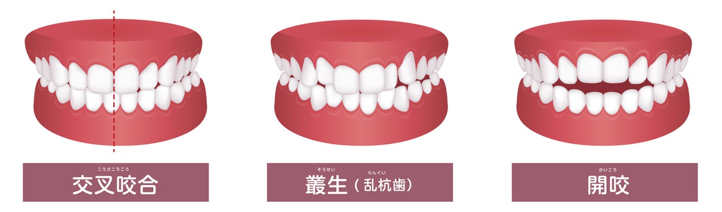 交叉咬合・叢生(乱杭歯)・開咬